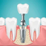 What Happens to Surrounding Bone Density When Dental Implants Are Delayed After Tooth Loss