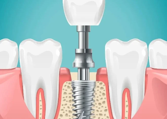 What Happens to Surrounding Bone Density When Dental Implants Are Delayed After Tooth Loss
