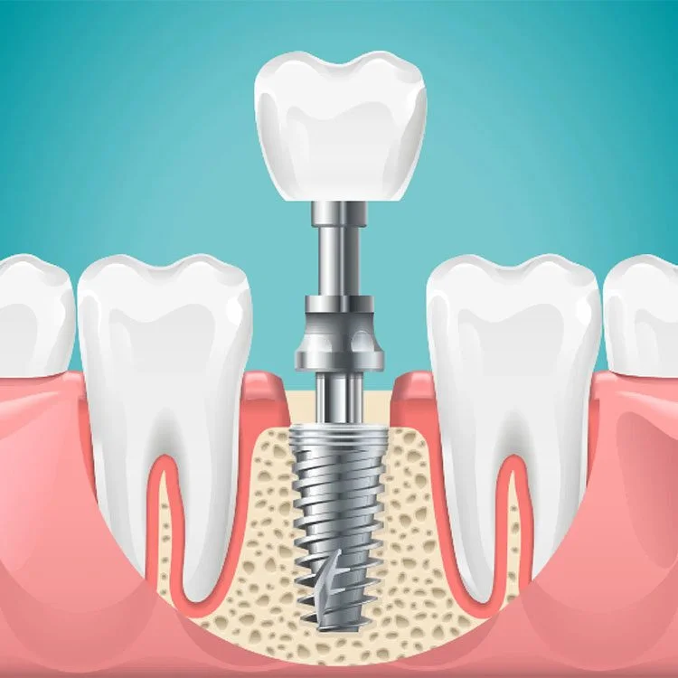 What Happens to Surrounding Bone Density When Dental Implants Are Delayed After Tooth Loss